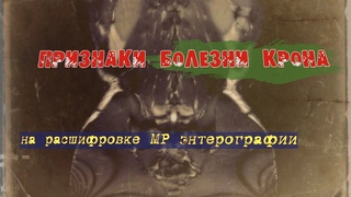 Признаки БОЛЕЗНИ Крона, ДОПОЛНИТЕЛЬНЫЕ ПЕТЛИ кишечника на РАСШИФРОВКЕ МРТ тонкого кишечника